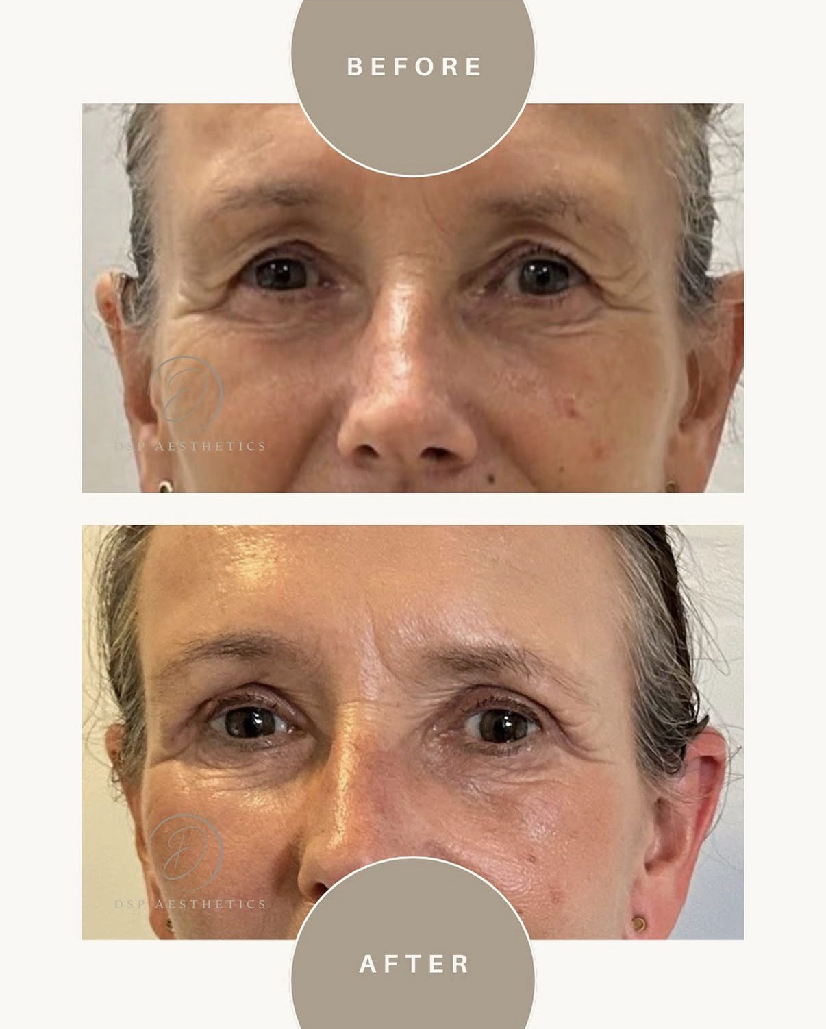 dsp-ooglidcorrectie-1