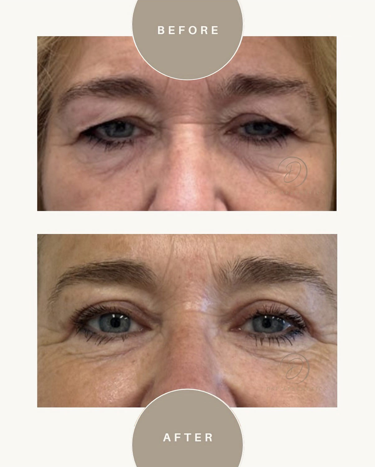 dsp-ooglidcorrectie-2