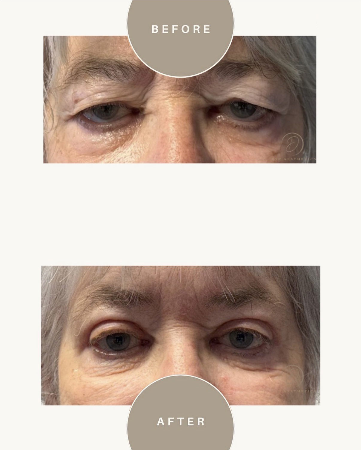 dsp-ooglidcorrectie-3