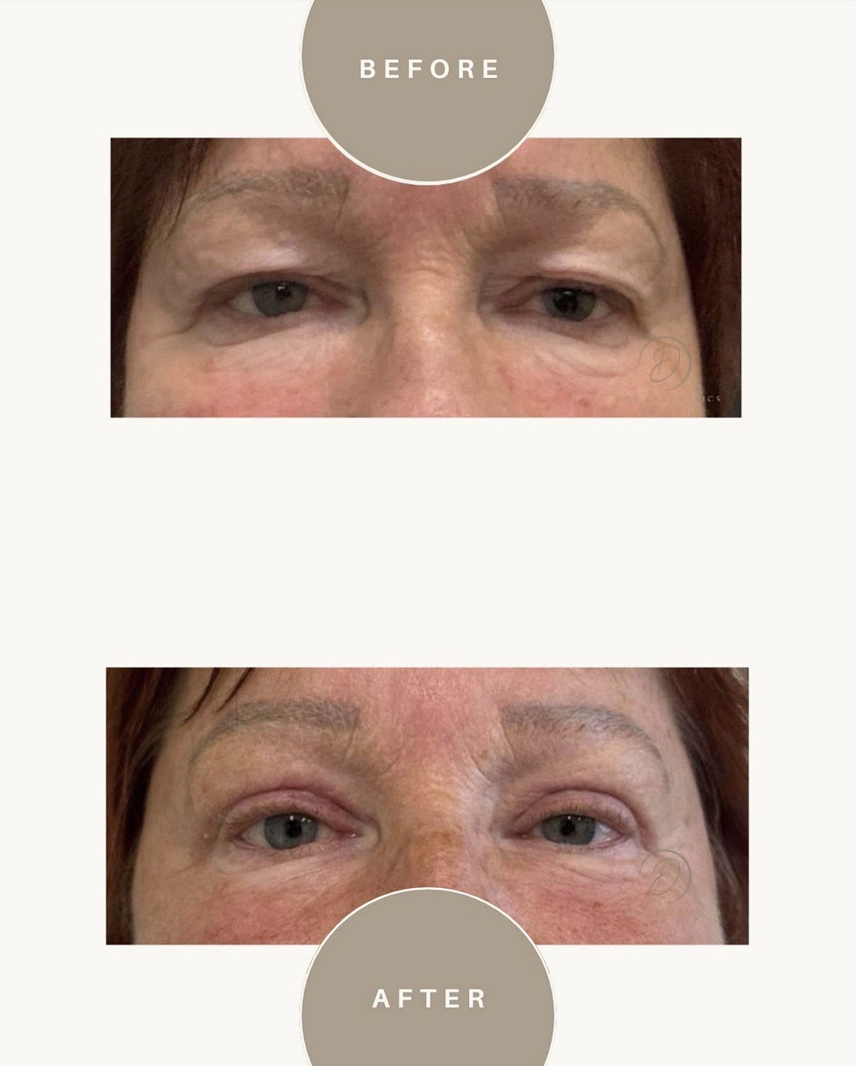 dsp-ooglidcorrectie-4