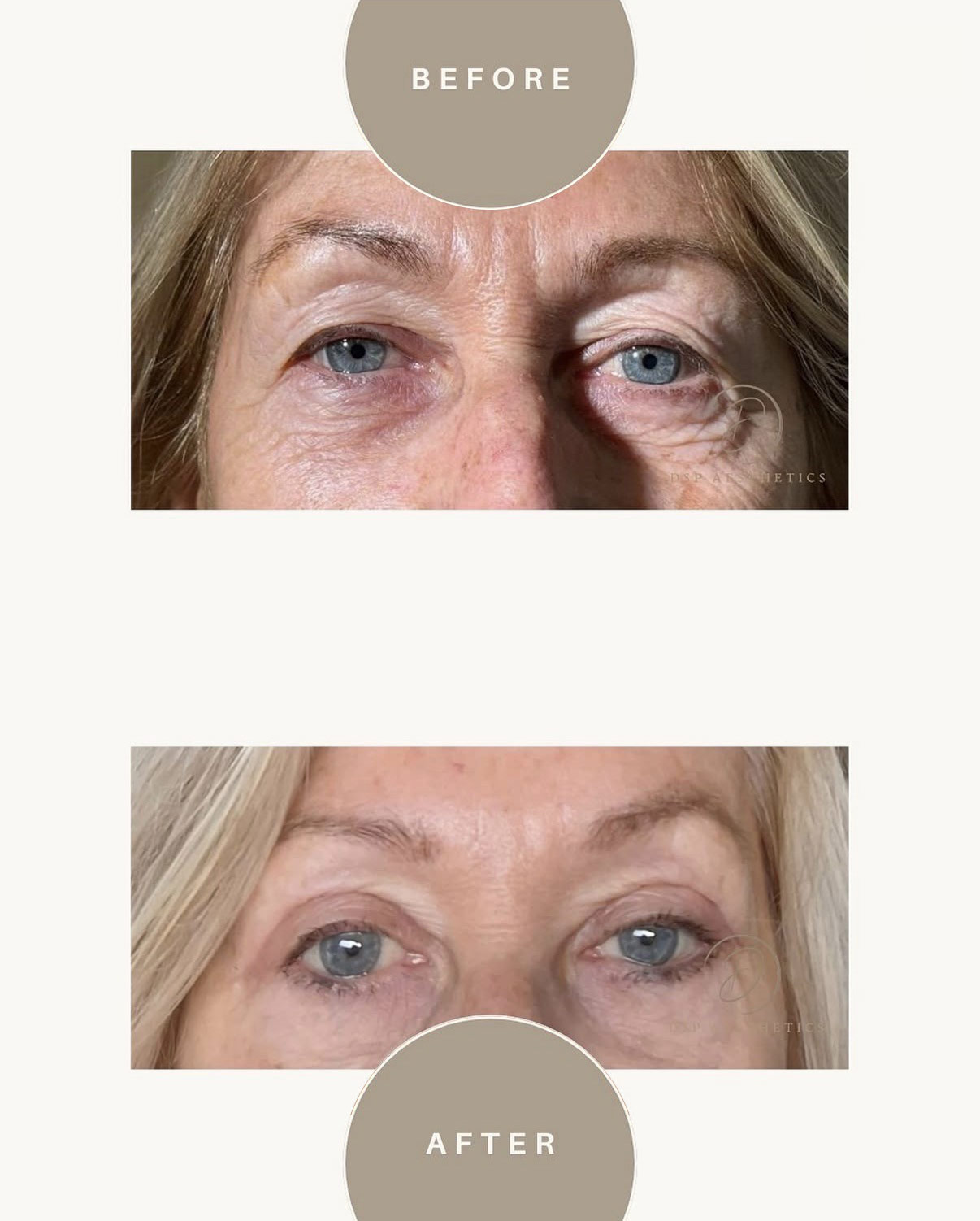 dsp-ooglidcorrectie-6