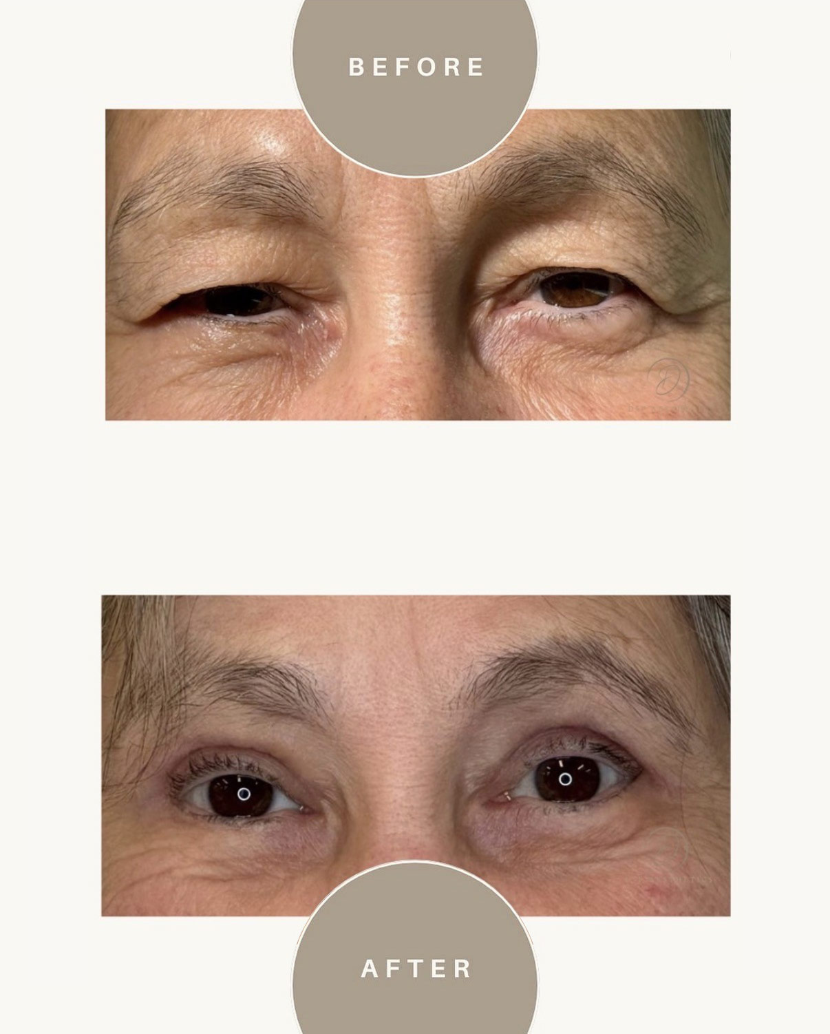 dsp-ooglidcorrectie-8